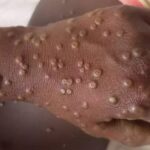 Mpox